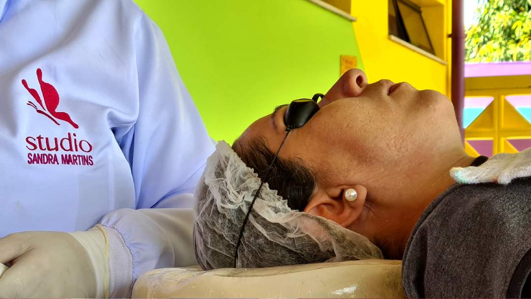 Descubra os Incríveis Benefícios do Microagulhamento e da Fototerapia no Tratamento de mancha de acne, com a estimulação do colágeno da pele.