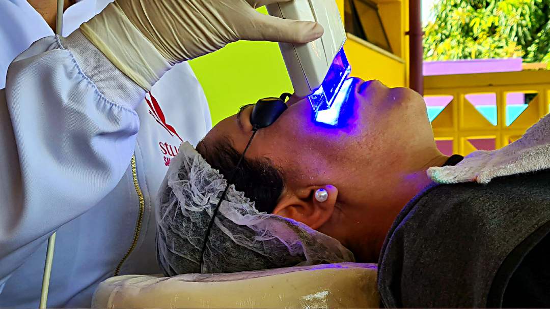 Descubra os Incríveis Benefícios do Microagulhamento e da Fototerapia no Tratamento de mancha de acne, com a estimulação do colágeno da pele.