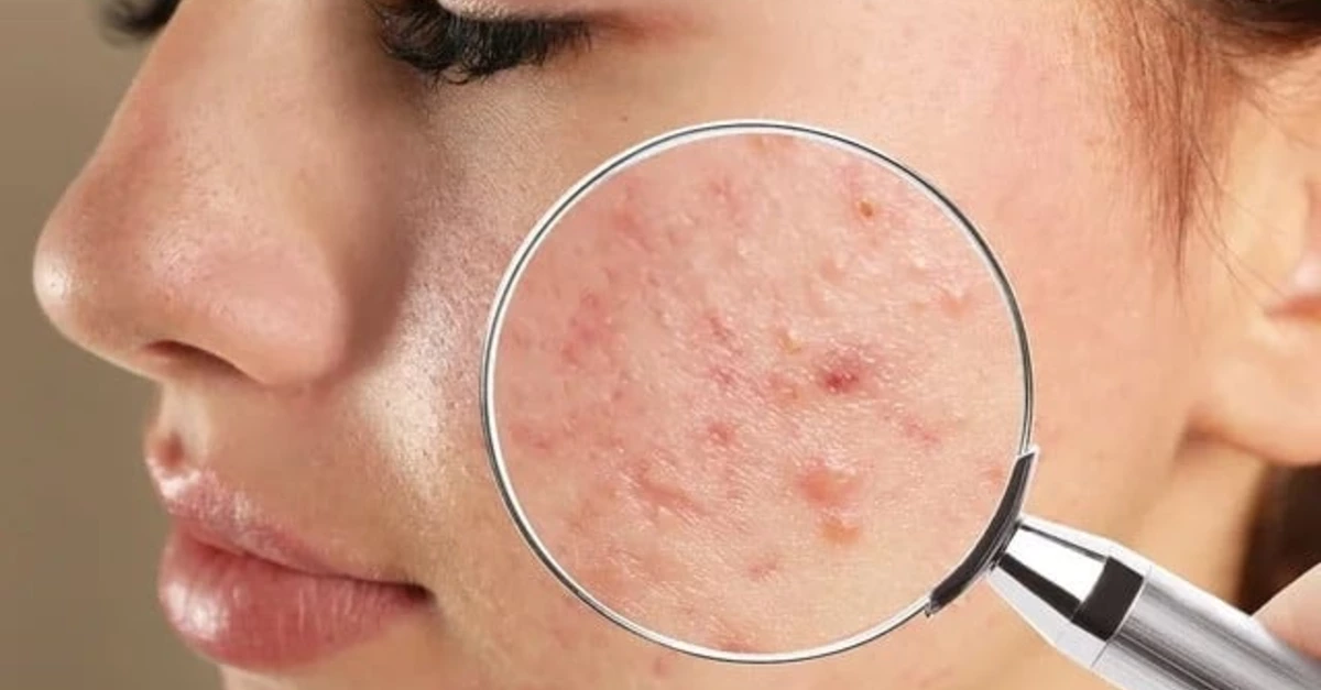 A todos que treinam na Spaço Fitness, Bio Fit e Smart Fit (na M Norte e L Norte em Taguatinga) confira dicas para pele oleosa e com acne e faz musculação!