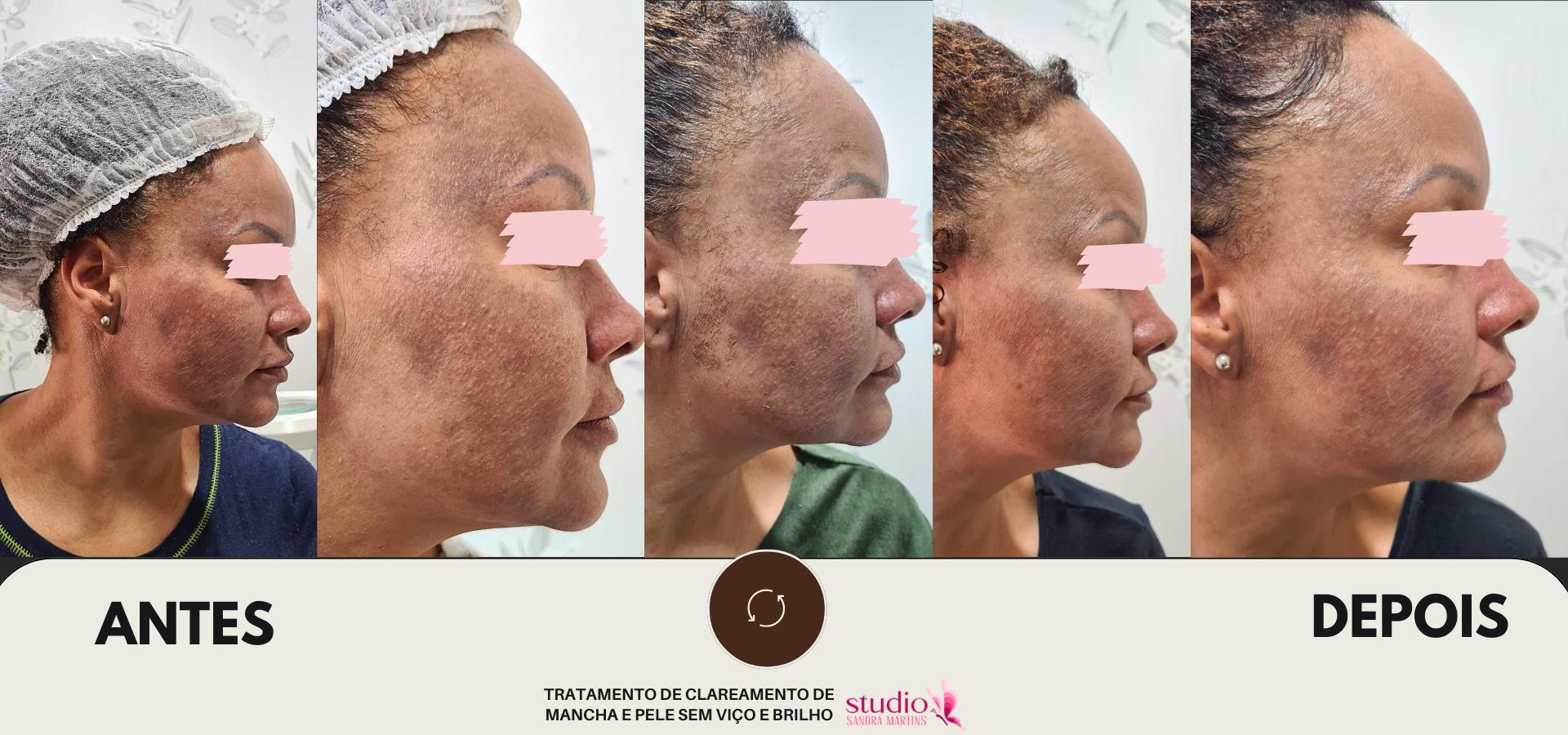 Microagulhamento antes e depois abril 26, 2024 Studio Sandra Martins de Estética Facial