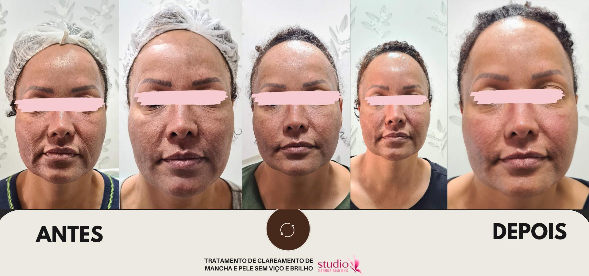 Microagulhamento antes e depois abril 26, 2024 Studio Sandra Martins de Estética Facial