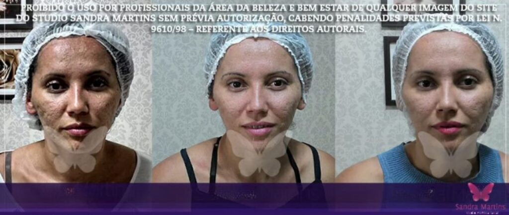 Promoções de estética facial em Taguatinga (Brasília) dezembro 21, 2024 Studio Sandra Martins de Estética Facial