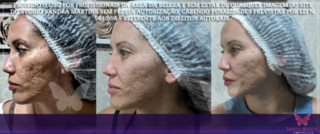 Promoções de estética facial em Taguatinga (Brasília) dezembro 21, 2024 Studio Sandra Martins de Estética Facial