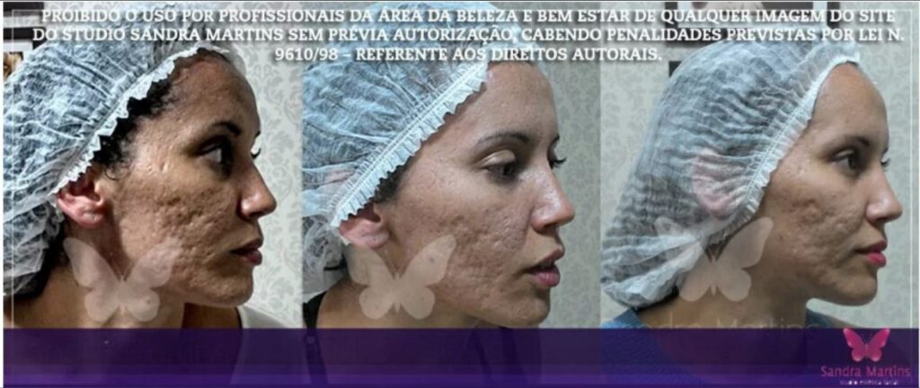 Promoções de estética facial em Taguatinga (Brasília) dezembro 21, 2024 Studio Sandra Martins de Estética Facial