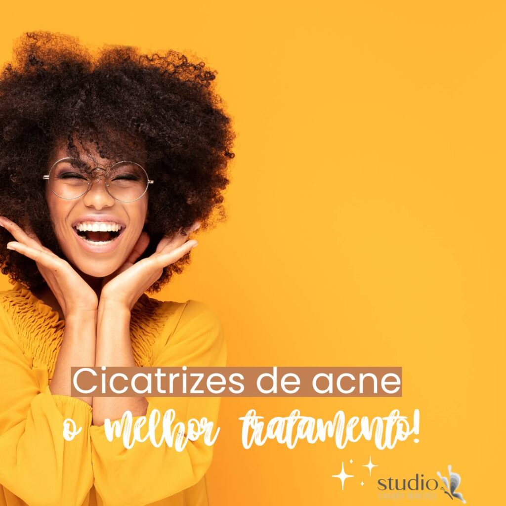 Microagulhamento para Preenchimento de Cicatrizes Acne Brasília: Reestruturando sua Pele com o Studio Sandra Martins