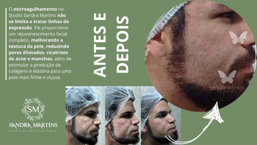 Sandra Martins é referência em resultados em tratamentos com microagulhamento em Brasília. O melhor microagulhamento de Taguatinga para cicatriz de acne e manchas