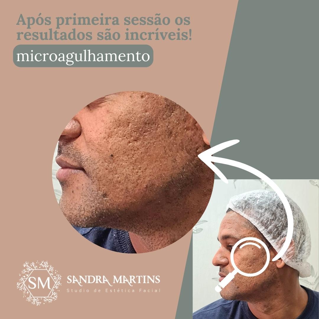Se você está pesquisando microagulhamento em Brasília para cicatriz de acne, provavelmente já tentou: – Cremes clareadores – Ácidos – Tratamentos caseiros – Peelings superficiais – Produtos caros que prometeram milagres E talvez os resultados tenham sido limitados. Então surge a dúvida: Microagulhamento realmente funciona para cicatriz de acne ou é só mais uma promessa? A resposta curta é: Sim, ajuda — quando bem indicado e bem executado. Mas existe uma resposta mais completa, e é isso que você precisa entender antes de decidir. Sou Sandra Martins, esteticista graduada, atuando desde 2010 em Taguatinga, atendendo clientes de toda Brasília – DF. O microagulhamento é um dos procedimentos mais eficazes que utilizo para tratar cicatrizes de acne. Mas ele não é mágica. É ciência aplicada com técnica.
