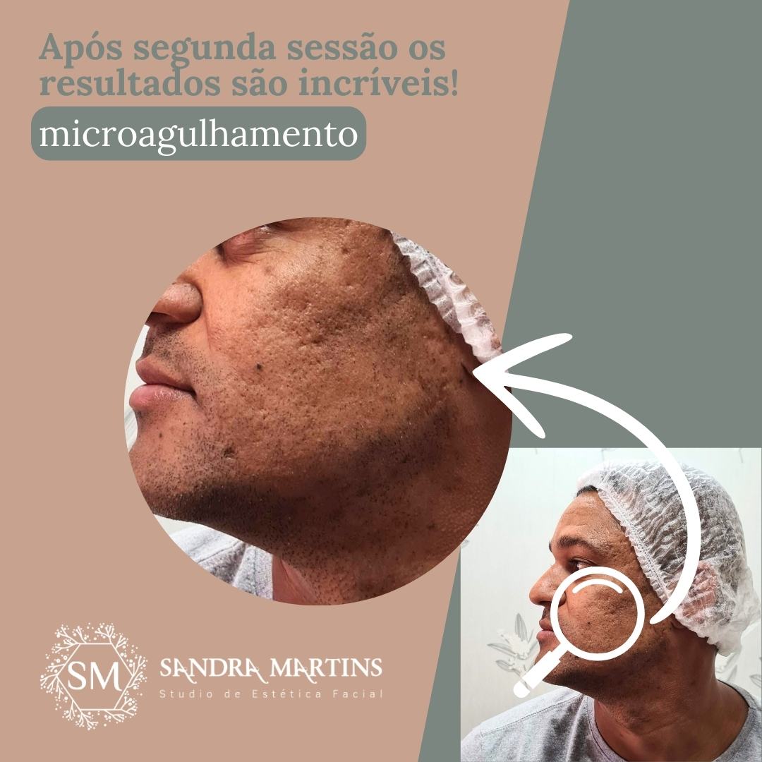 Se você está pesquisando microagulhamento em Brasília para cicatriz de acne, provavelmente já tentou: – Cremes clareadores – Ácidos – Tratamentos caseiros – Peelings superficiais – Produtos caros que prometeram milagres E talvez os resultados tenham sido limitados. Então surge a dúvida: Microagulhamento realmente funciona para cicatriz de acne ou é só mais uma promessa? A resposta curta é: Sim, ajuda — quando bem indicado e bem executado. Mas existe uma resposta mais completa, e é isso que você precisa entender antes de decidir. Sou Sandra Martins, esteticista graduada, atuando desde 2010 em Taguatinga, atendendo clientes de toda Brasília – DF. O microagulhamento é um dos procedimentos mais eficazes que utilizo para tratar cicatrizes de acne. Mas ele não é mágica. É ciência aplicada com técnica.