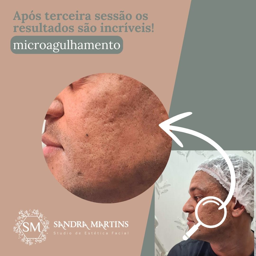 Se você está pesquisando microagulhamento em Brasília para cicatriz de acne, provavelmente já tentou: – Cremes clareadores – Ácidos – Tratamentos caseiros – Peelings superficiais – Produtos caros que prometeram milagres E talvez os resultados tenham sido limitados. Então surge a dúvida: Microagulhamento realmente funciona para cicatriz de acne ou é só mais uma promessa? A resposta curta é: Sim, ajuda — quando bem indicado e bem executado. Mas existe uma resposta mais completa, e é isso que você precisa entender antes de decidir. Sou Sandra Martins, esteticista graduada, atuando desde 2010 em Taguatinga, atendendo clientes de toda Brasília – DF. O microagulhamento é um dos procedimentos mais eficazes que utilizo para tratar cicatrizes de acne. Mas ele não é mágica. É ciência aplicada com técnica.