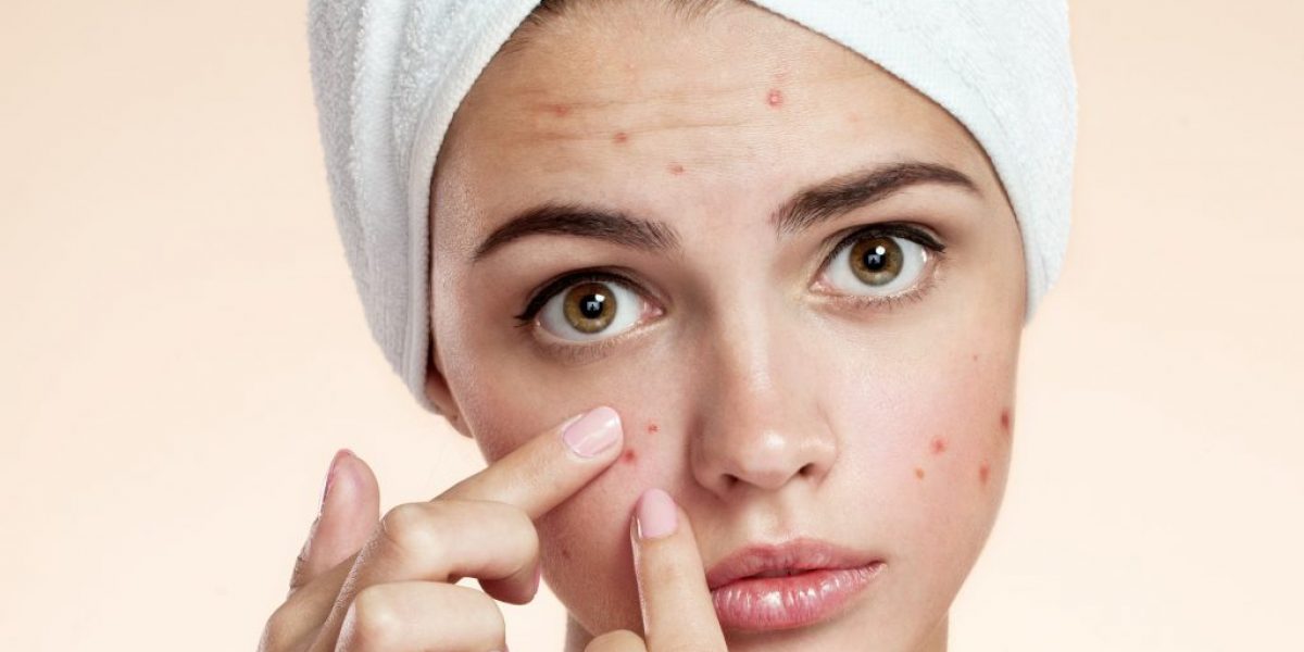 Mulheres têm quatro vezes mais chances de ter acne na fase adulta