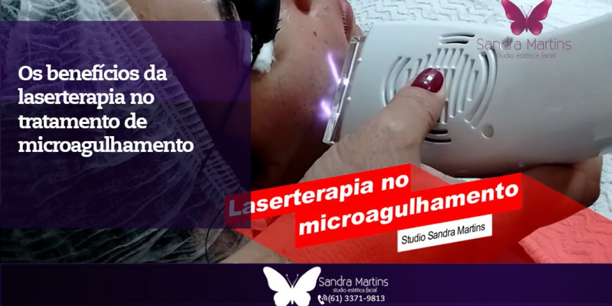 Você ainda não sabe o que é o microagulhamento? Conheça o tratamento e o benefício da laserterapia contra as cicatrizes de acne em Brasília.