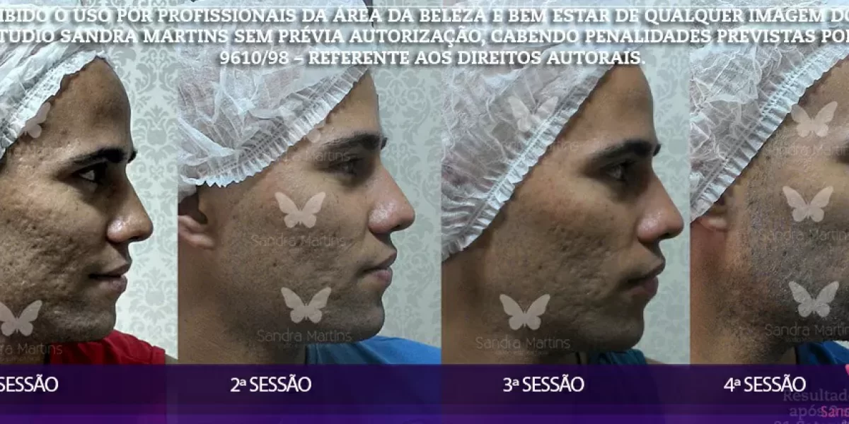 Confira alguns antes e depois de clientes que já realizaram tratamentos faciais com microagulhamento em Brasília do Studio Sandra Martins