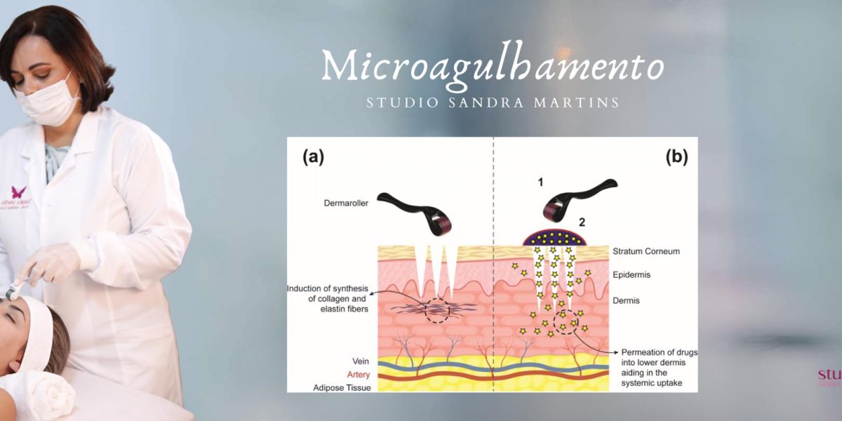 Microagulhamento na Ceilândia: Diga Adeus às Marcas do Passado e Recupere a Beleza da Sua Pele! Você já se olhou no espelho e se sentiu incomodada com as marcas de acne que insistem em te acompanhar? Aquelas cicatrizes que te lembram do passado e te impedem de se sentir confiante e radiante?