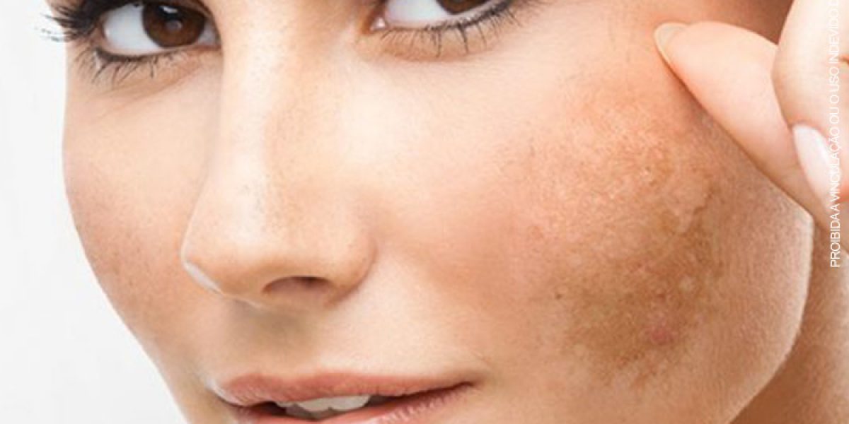 O Melasma se caracteriza por manchas escuras na pele, geralmente na face, mas que também podem aparecer em outras partes do corpo, como colo, braços e pescoço. Sua incidência é mais comum em mulheres entre os 20 e 50 anos, porém também pode afetar os homens