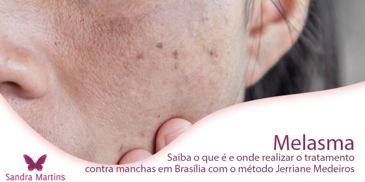 saiba-o-que-e-e-onde-realizar-o-tratamento-contra-manchas-em-Brasilia-com-o-metodo-Jerriane-Medeiros