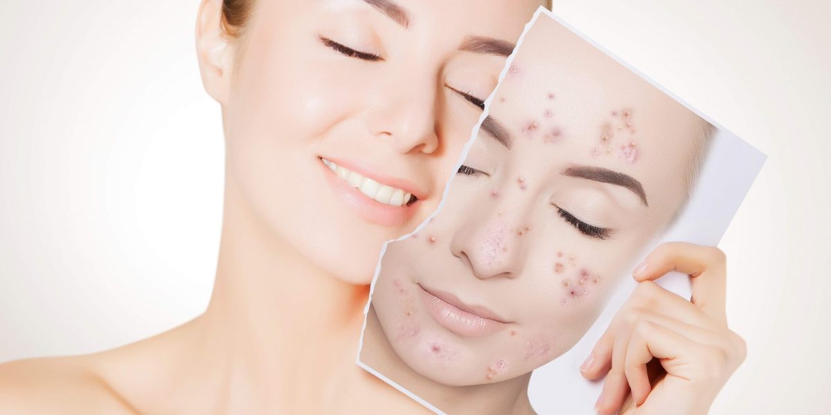 Tratamento para acne resseca a pele? Entenda se o tratamento para a acne resseca a pele e que fazer se isso acontecer